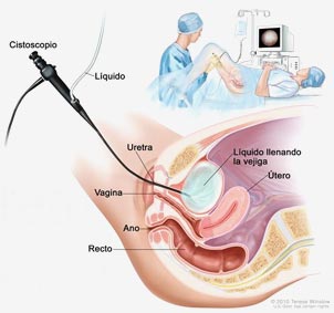 cistoscopia